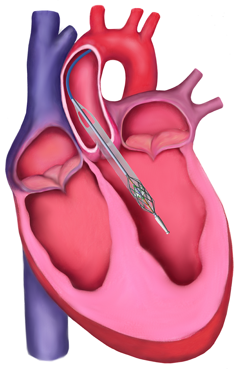 Magenta Medical Raises $55M for World’s Smallest Heart Pump
